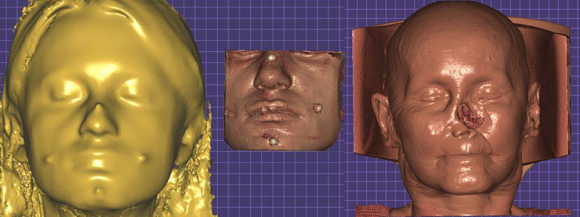 Использование аддитивных технологий в челюстно-лицевом протезировании1.jpg